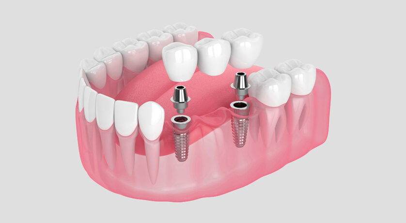 Dental Bridges