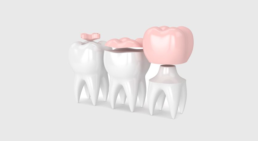 When Should You Choose an Inlay or Onlay for a Damaged Tooth?