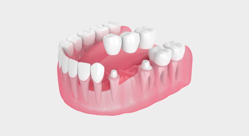 Can Dental Bridges Replace Multiple Missing Teeth?